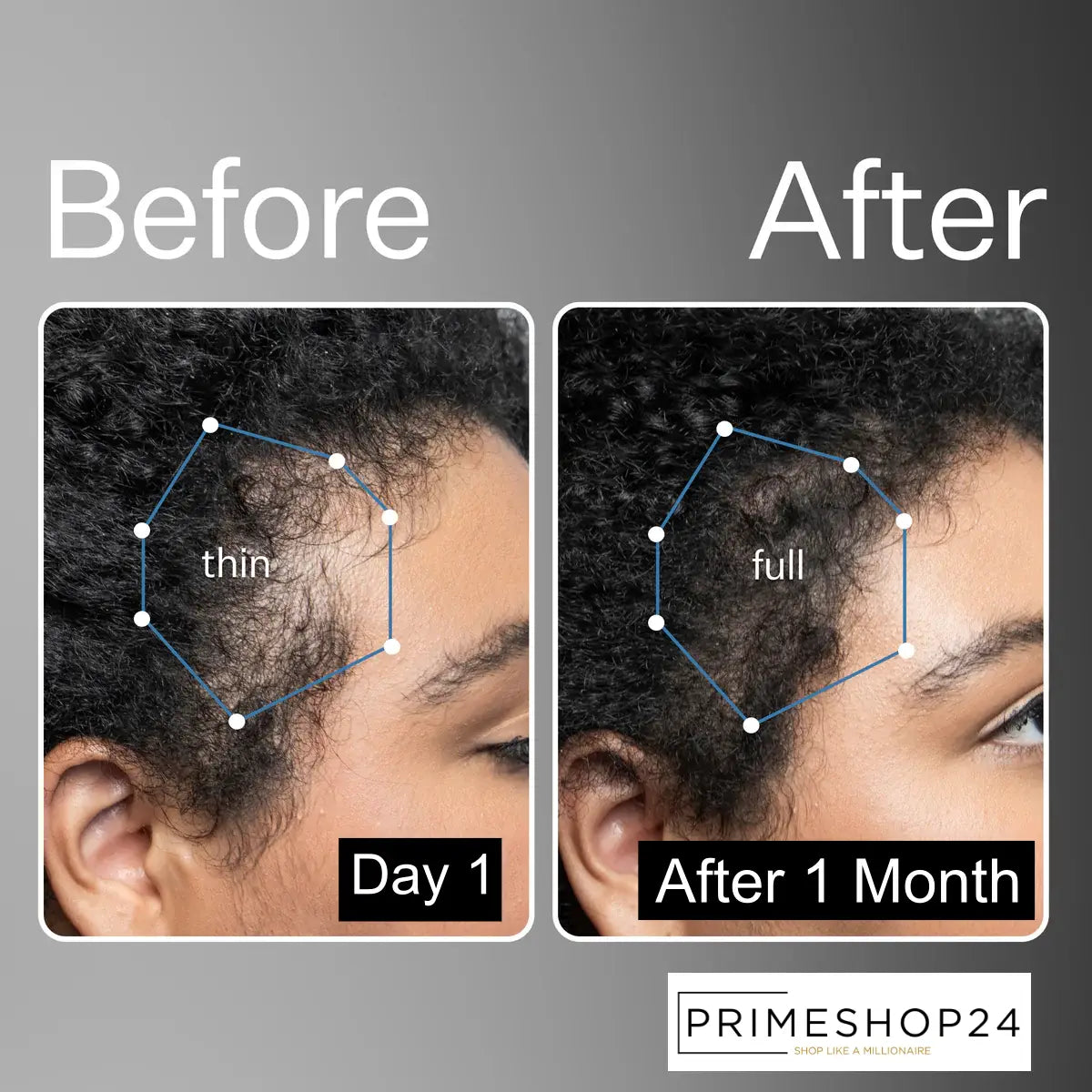 Prime Derma Roller 0.5mm (Pack of 2) For Hair Growth