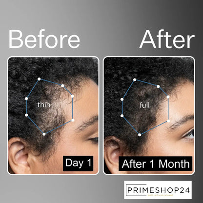 Prime Derma Roller 0.5mm (Pack of 2) For Hair Growth